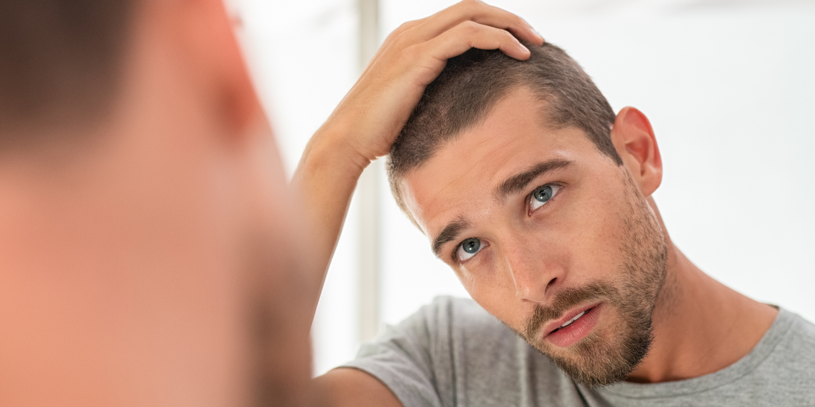 Do Steroids Cause Hair Loss?